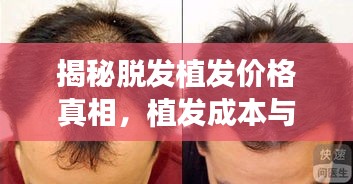 揭秘脫發(fā)植發(fā)價(jià)格真相，植發(fā)成本與最佳方案選擇全解析