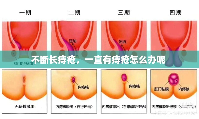 不斷長(zhǎng)痔瘡，一直有痔瘡怎么辦呢 