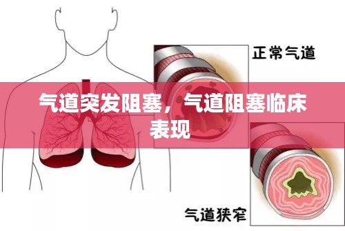 氣道突發(fā)阻塞，氣道阻塞臨床表現(xiàn) 