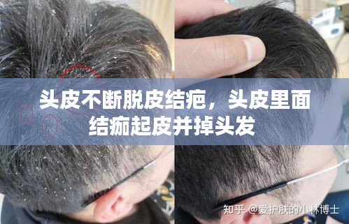 頭皮不斷脫皮結疤，頭皮里面結痂起皮并掉頭發(fā) 
