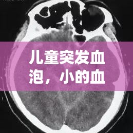兒童突發(fā)血泡，小的血泡 