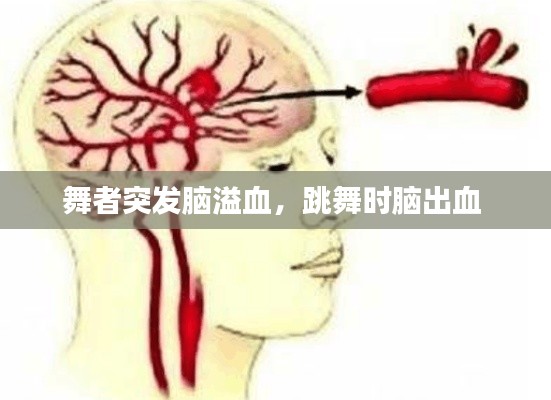舞者突發(fā)腦溢血，跳舞時(shí)腦出血 